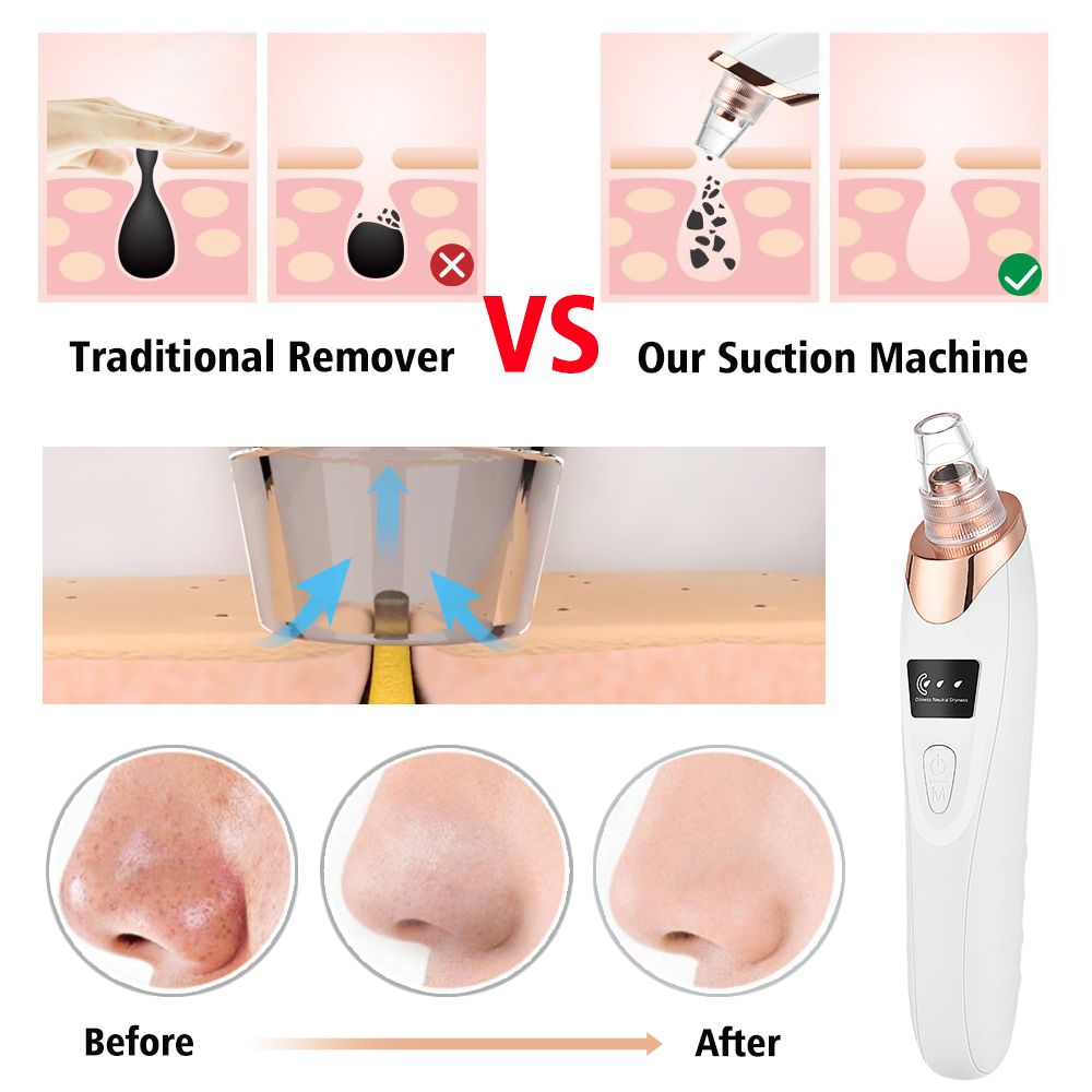 Removedor de espinillas, limpi - Nasal Aspirator reseña y precio